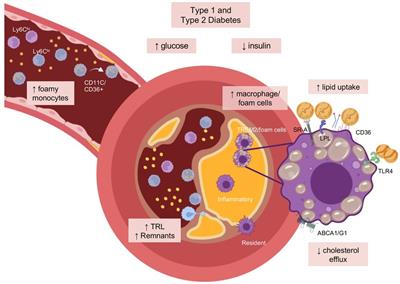 Monocyte and macrophage foam cells in diabetes-accelerated atherosclerosis